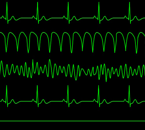 From top to bottom: normal sinus rhytm, ventricular tachycardia, ventricular fibrillation, pulseless electrical activity, asystole